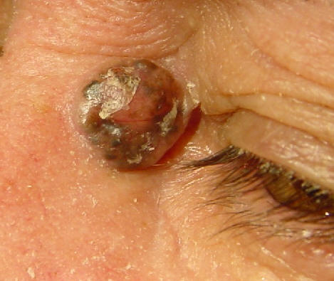 Carcinoma basocelular nodular pigmentado