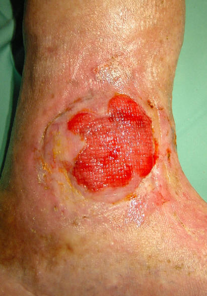 Carcinoma basocelular nodular ulcerado. Paciente de 60 aos, que 40 aos antes haba recibido tratamiento con radioterapia para una lesion vascular presente en le nacimiento. 