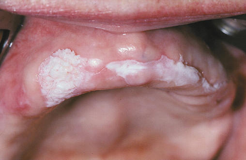 Leucoplasia. El estudio histolgico de la lesin ms verrucosa mostr la presencia de un carcinoma epidermoide bien diferenciado