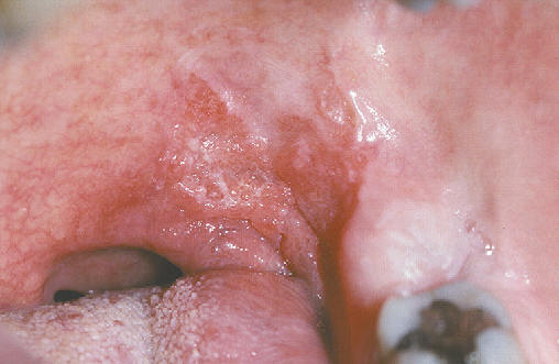 Placa eritematosa, granular en la cara lateral de la región tonsilar. El estudio histológico mostró un carcinoma epidermoide.