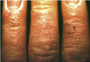 Lesiones de eczema afectando al dorso de manos
