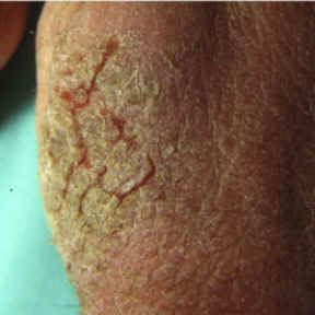 placa de eczema crnico con fisuracin