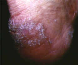 lesiones hiperqueratosicas en talon