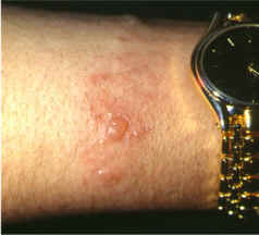 imagen de dermatitis de contacto al niquel (reloj)