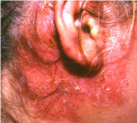 imagen de dermatitis de contacto por pendientes (niquel)