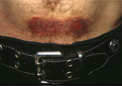 imagen de dermatitis de contacto por niquel (cinturon)