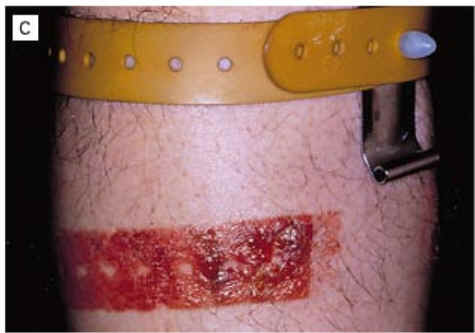 dermatitis de contacto alrgica a las gomas. (NEJM)