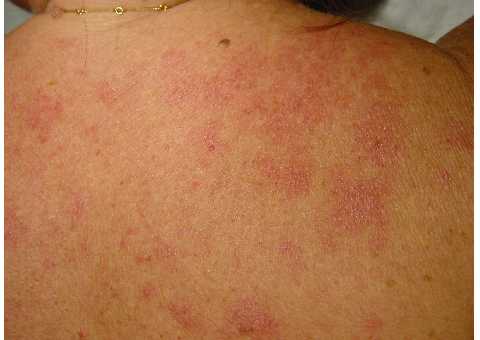 Paciente con placas cutneas psoriasiformes en la espalda, exacerbadas tras la exposicin solar, anticuerpos antiRo+