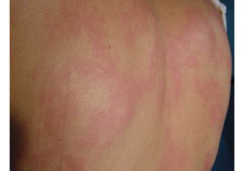 Paciente con lupus eritematoso subagudo y placas cutneas anulares en la espalda exacerbadas tras la exposicin solar