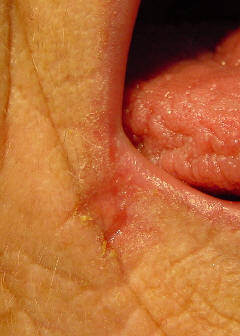 Candidiasis perioral o perleche