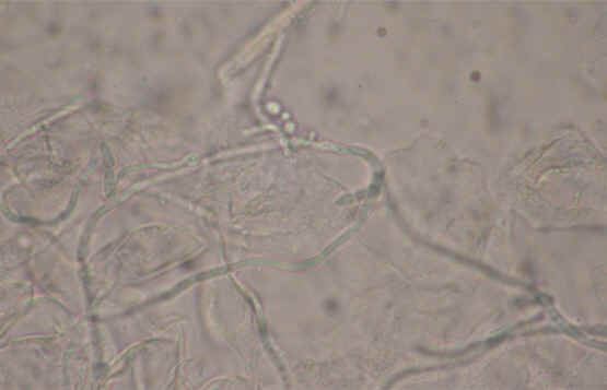 El examen directo con KOH de la muestra obtenida de una de las pustulas mostr la presencia de esporas y pseudohifas caractersticas de la infeccin por Candida