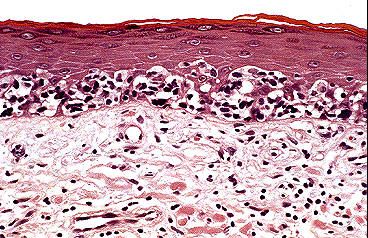 Patron arquitectural epidermotropo caracterstico de los linfomas cutneos de clulas T, tipo micosis fungoide. Existe un elevado numero de clulas atipicas ocupando las porciones inferiores de la epidermis