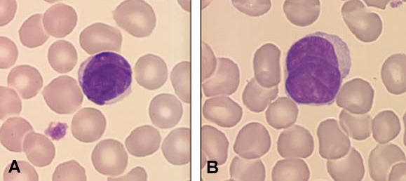 Microfotografia de una clula de Sezary pequea (A) y grande (B) de pacientes con enfermedad de Sezary. Imagen de G. Flandrin JAAD 2002, 46:95-106