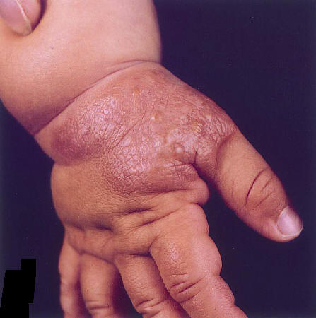 Mastocitoma (mastocitosisis nodular). nodulo solitario, bien definido, marronaceo en un nio de 6 meses. Cuando se frota sobre el mismo se produce una urticacin e incluso la formacin de ampollas