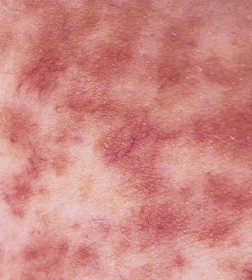 detalle de las lesiones de telangiectasia macular eruptiva