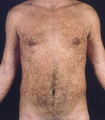 Urticaria pigmentosa o mastocitosis maculopapular del adulto. Las lesiones son de menor tamao  que en la forma infantil