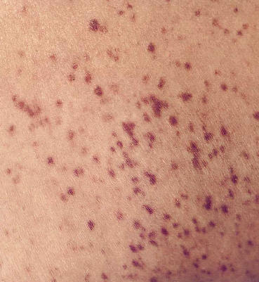 detalle de la urticaria pigmentosa del adulto