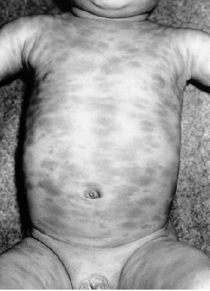 Urticaria pigmentosa. Hannaford R, Rogers M. Presentation of cutanous mascotcytosis in 173 children. Austr J of Dermatology 2001, 42:15-21.