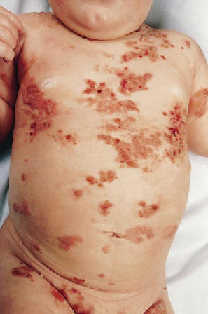 Mastocitosis cutnea difusa,cpn extensas ampollas hemorragicas. Hannaford R, Rogers M. Presentation of cutanous mascotcytosis in 173 children. Austr J of Dermatology 2001, 42:15-21.