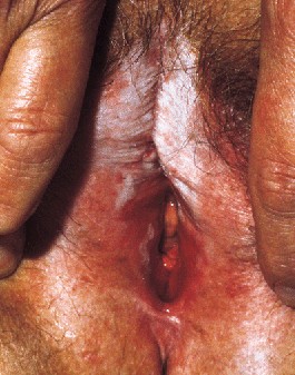 Lesiones de liquen escleroso en la vulva mostrando areas con papulas blanquecinas, atrofia, reabsorcin y fusin de los labiosshowing pallor, fusion, atrofia y reabsorcin de los labios. Lancet 1999; 353: 1777-83 