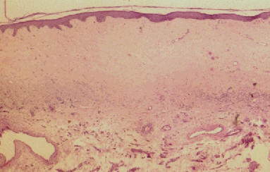 biopsia de una lesin de liquen escleroso y atrofico mostrando atrofia epidermic marcada y homogenizacin y edema de dermis papilar con desaparicin de las estructuras anexiales