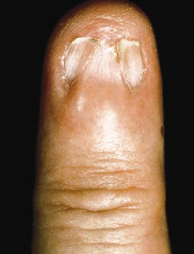 Liquen plano ungueal produciendo prdida de la ua y pterigium caracterstico.  Genadry R, Provost TT. Miscellaneus diseases cap 70 in cutaneous medicine. M. Decker 2000.