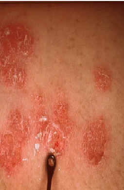 signo de Auspitz. El rascado metdico de las escamas que cubren las placas de psoriasis dejan al descubierto un rea eritematosa en la que se observan pequeos puntos hemorrgicos.
