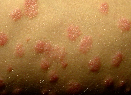 Ppulas y placas eritematosas de pequeo tamao, bien delimitadas caractersticas de la psoriasis en gotas