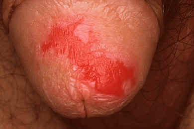 Psoriasis del pene. Placa eritematosa bien delimitada. Lachapelle JM: Atlas of Dermatology. UCB pharmaceuticals