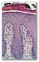 Acantosis epidermica con atrofia epidermica suprapapilar, hiperqueratosis con paraqueratosis y presencia en dermis de vasos capilares dilatados y de trayectos tortuosos asi como modeado infiltrado inflamatorio de predominio linfocítico.