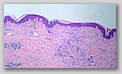 Biopsia cutánea que muestra atrofia epidermica con atrofia de las crestas epidermicas interpapilares y presencia de denso infiltrado linfocitario eb dermis papilar y media de distribución intersticial 