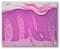 acantosis epidérmica interpapilar, hipergranulosis suprapapilar 