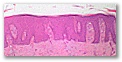 hiperplasia epidérmica marcada con acantosis epidérmica 