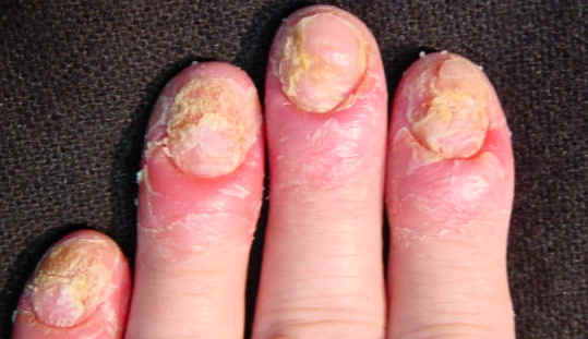 psoriasis ungueal