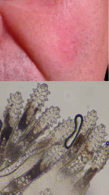 Placa eritematosa de curso crnico en las mejillas, sobre la que ocasionalmente se observan pstulas. El examen directo de una muestra obtenida de la superficie revela la presencia de numerosos demodex foliculorum.