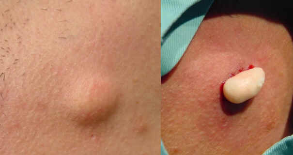 Quiste  epidermico. Clnicamente se observa una lesin tumoral localizada en dermis y tejido subcutneo, conectada a la epidermis por un folculo del que con frecuencia se obtiene material blanquecino. La extirpacin quirrgica muestra una lesion revestida de una capsula blanquecina conteniendo restos de queratina y secrecin sebcea.