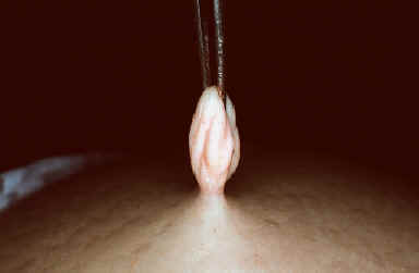 fibroma blando. Lachapelle MM. Atlas de dermatologia. UCB pharmaceuticals