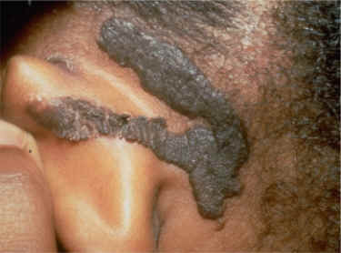 imagen de nevus epidermico en cuero cabelludo (AAD)