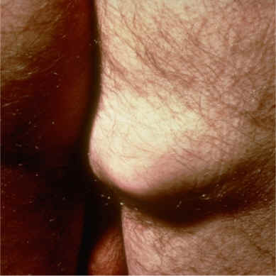 imagen clnica de lipoma (AAD)