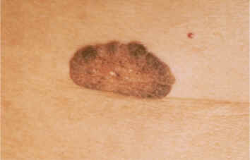 queratosis seborreica plana