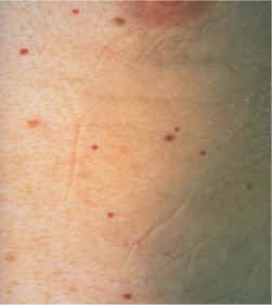 imagen de angioma rubi (AAD)
