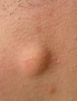 quiste epidrmico del cuello. Ndulo facilmente desplazable.