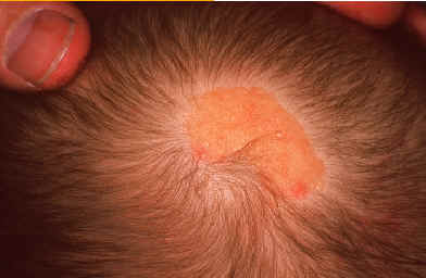 Nevus sebceo. Se trata de un tumor localizado preferentemente en el cuero cabelludo y que est presente desde el nacimiento mostrandose como una placa de alopecia que con el curso de los aos presenta un desarrollo verrucoso, de color amarillento y en un porcentaje alto de casos en la edad adulta desarrolla un carcinoma basocelular o un siringocistoadenoma papilifero. imagen de Lachapelle JM. Atlas de dermatologia. UCB pharmaceuticals.