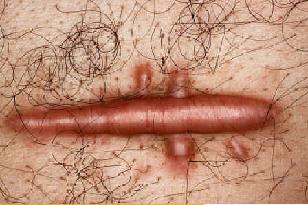 Queloide. Tumor benigno de consistencia dura pruriginoso aparecido tras una pequea intervencin quirrgica. Lachapelle JM: Atlas de Dermatologa. UCB pharmaceuticals