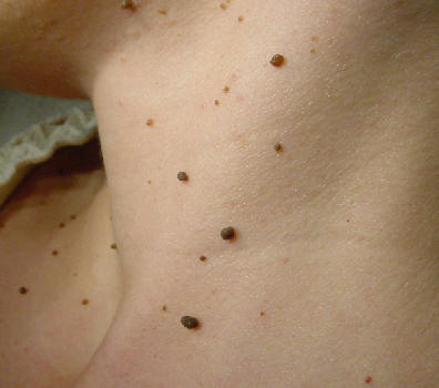 acrocordone multiples en cara lateral de cuello