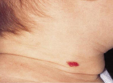 nio de 18 meses con un pequeo hemangioma cervical que no requiere ningun tratamiento y se resolver sin dejar cicatriz. North PE. Arch Dermatol 2001, 137:559.