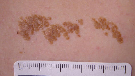 Nevus epidermico