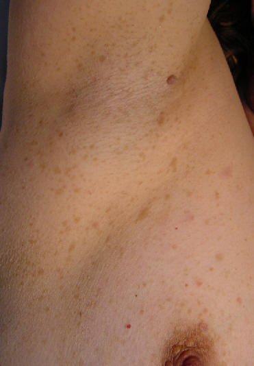 Neurofibromatosis. Signo de Crowe.