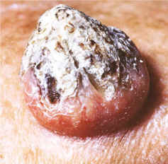 Imagen clnica de queratoacantoma. Lesion nodular endo-exoctica con un crater queratsico central. NEJM.
