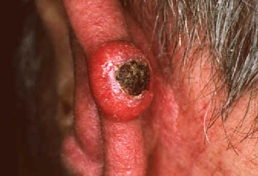 queratoacantoma. Lachapelle JM: _Atlas de dermatologia. UCB pharmaceuticals